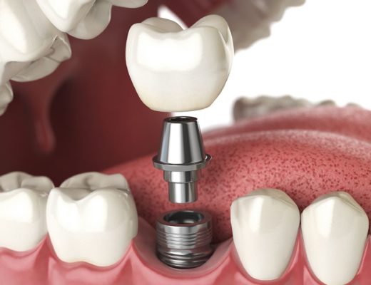 dental implants