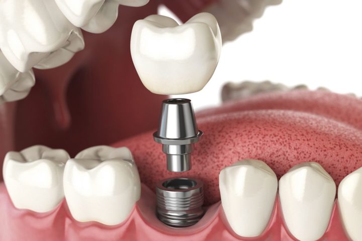 dental implants