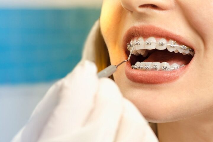 Orthodontic Care