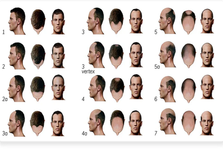 male hair loss treatment