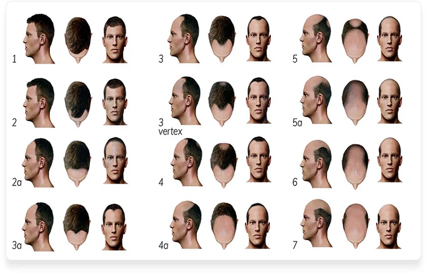 male hair loss treatment